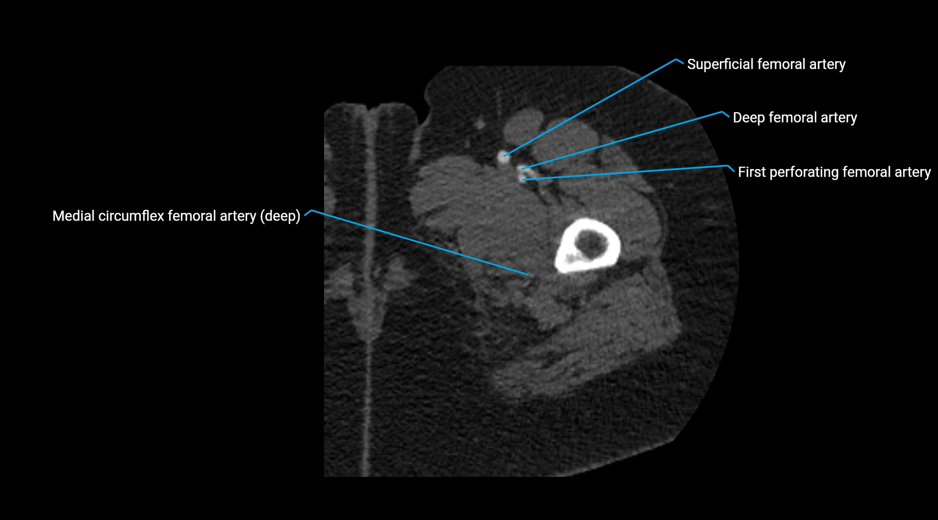 CTA lower limb cross sectional anatomy labelled image _79.webp